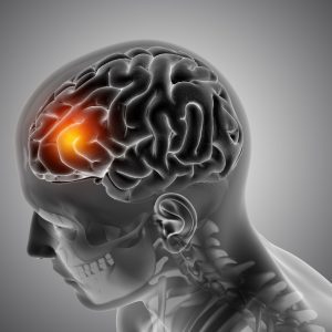 Neurologista alerta para a importância da prevenção do AVC no Sul do Brasil Neurologista alerta para a importância da prevenção do AVC no Sul do Brasil