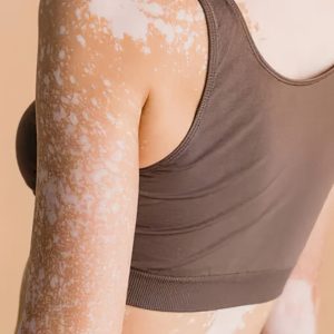 Vitiligo exige informação, acolhimento e combate ao preconceito