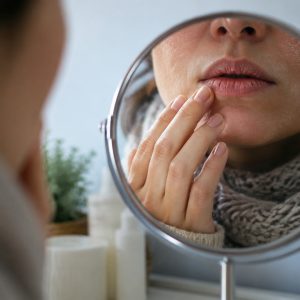 Lábios rachados e pele ressecada no inverno nem sempre são culpa apenas do frio