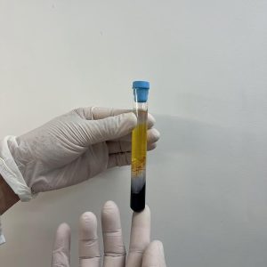 CFM regulamenta PRP em condições osteomusculares