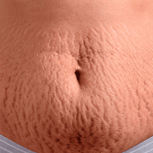 Cirurgia plástica e estética se aliam contra as estrias