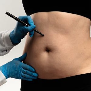 Lipoaspiração lidera preferência por cirurgias plásticas