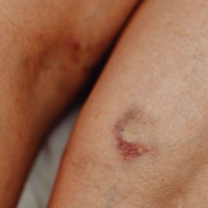 Alta mortalidade de doenças da aorta motiva congresso