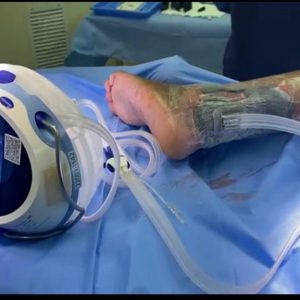 Brasil tem 12,3 milhões de adultos convivendo com diabetes