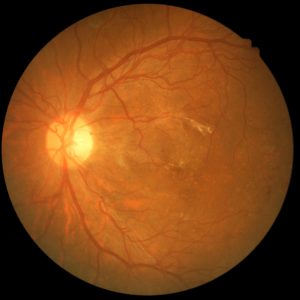 Descontrole das taxas de açúcar pode levar a retinopatia diabética
