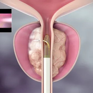 Técnica inovadora melhora a qualidade de vida de pacientes que sofrem com aumento da próstata