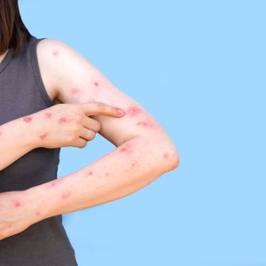 Brasil se aproxima de 90 casos confirmados de mpox