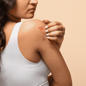 Mês da Dermatite Atópica: os impactos da doença na pele