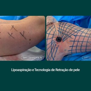 Tratamento remove flacidez do braço com tecnologia associada