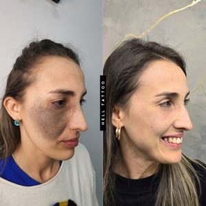 Nevo de Ota pode ser tratado com laser, explica biomédico