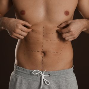 Definição em foco: a evolução da lipoaspiração masculina
