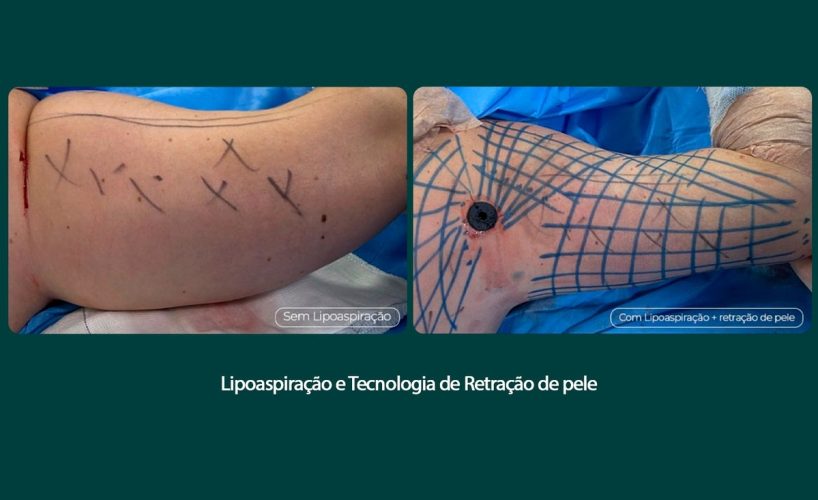Tratamento remove flacidez do braço com tecnologia associada