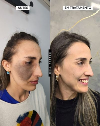 Nevo de Ota pode ser tratado com laser, explica biomédico