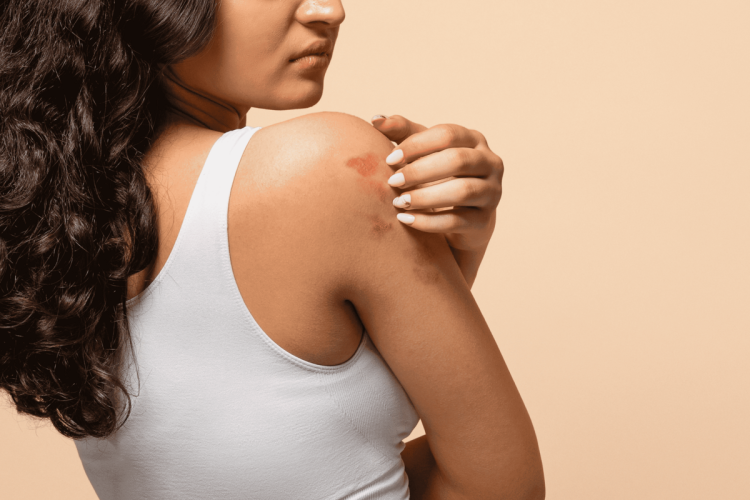 Mês da Dermatite Atópica: os impactos da doença na pele