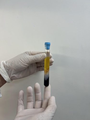 CFM regulamenta PRP em condições osteomusculares