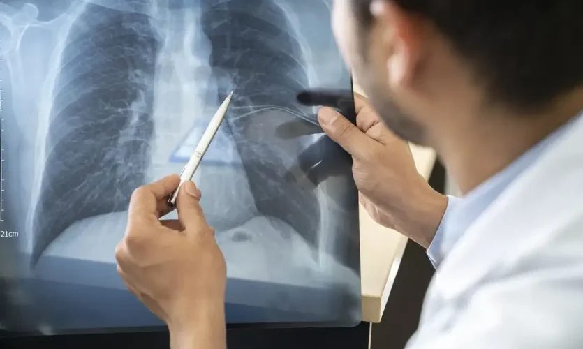 estagios-cancer-de-pulmao