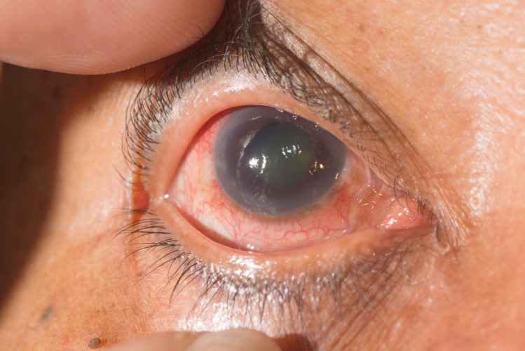 close up of the neo vascular glaucoma during eye examination.