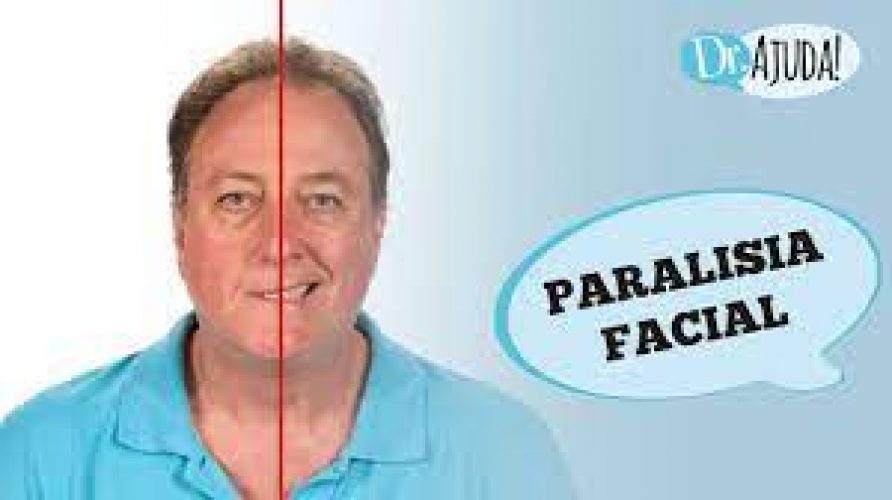 paralisia_facial